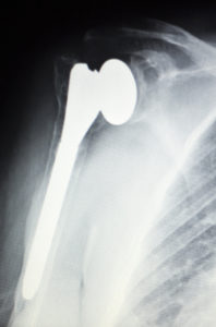 Shoulder Replacement Surgery