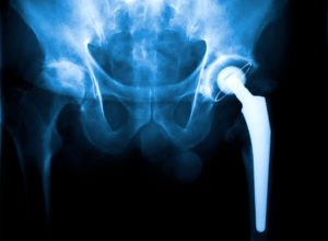An x-ray of an individual who has undergone a hip replacement surgery.