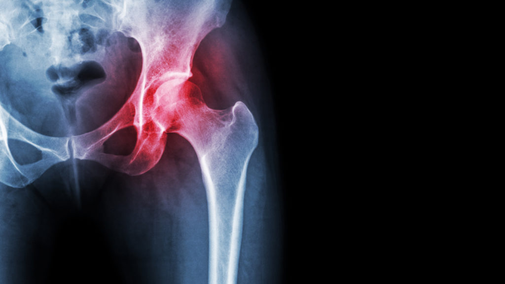 Xray of a hip joint with arthritis