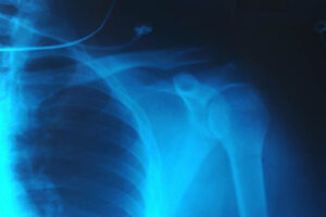 X-ray of my shoulder.