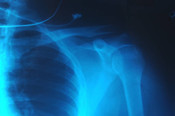 X-ray of my shoulder.