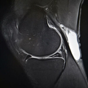Meniscal tear, Knee MRI