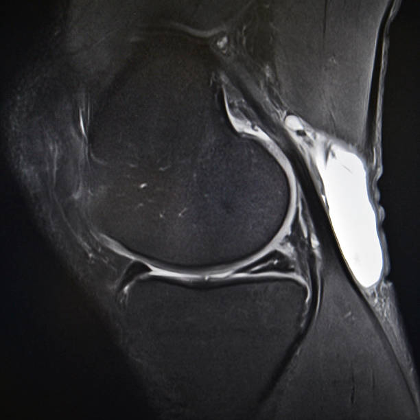 Meniscal tear, Knee MRI