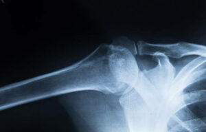 X-ray of shoulder joint show fracture clavicle