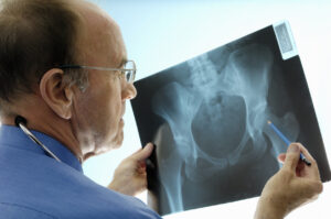 Orthopaedic surgeon consulting pelvic x-rays for a hip replacement