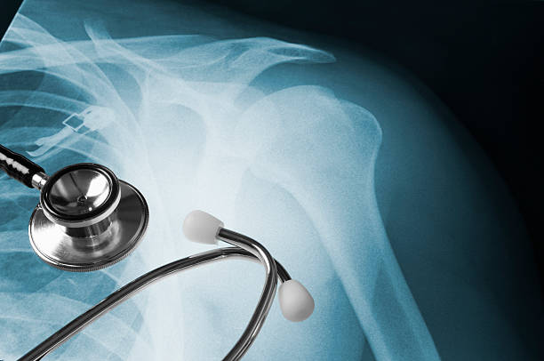 A medical stethoscope is lying on top of an Xray of a human shoulder. The Xray is on a light box showing a dislocated shoulder joint. There is copy space on the right hand side of the image. The stethoscope is silver with white ear pieces for the doctor to listen through.