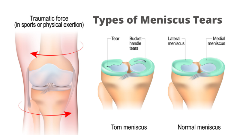 Types Of Mensical Tear