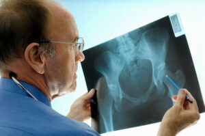 Orthopaedic surgeon consulting pelvic x-rays for a hip replacement