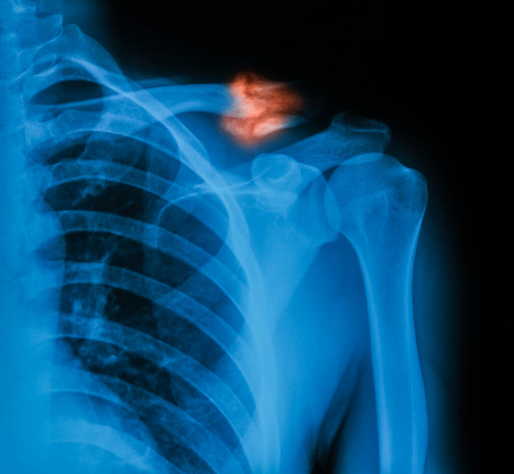 X-ray image of broken collarbone.