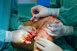 Surgeons who specialize in orthopedics conduct operations on patient's leg to treat injuries.