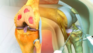 A 3D illustration of knee joint pain, tendon issues, and joint inflammation due to a meniscal tear injury.