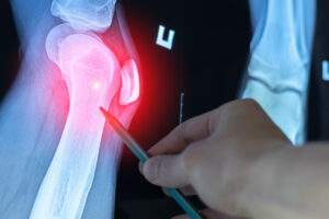 A close-up X-ray scan of a knee joint held by a bone Doctor while examining for diagnosis.