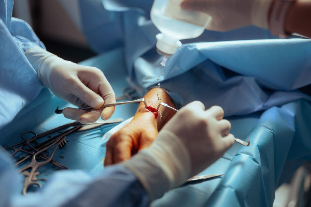 A hand surgeon is applying a disinfectant solution to the surgical incision during hand surgery.