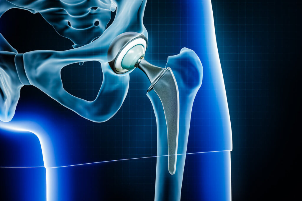 3D rendering illustration of Total hip joint replacement surgery or arthroplasty.