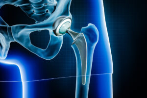 3D rendering illustration of Total hip joint replacement surgery or arthroplasty.