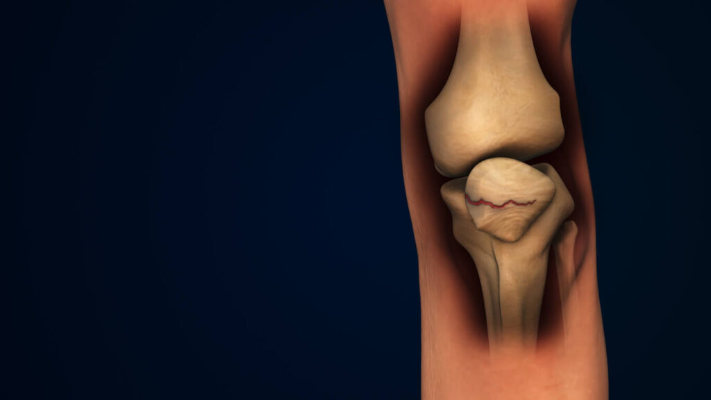 Leg bone Fracture or inflammation of human knee cap caused by meniscus tear.
