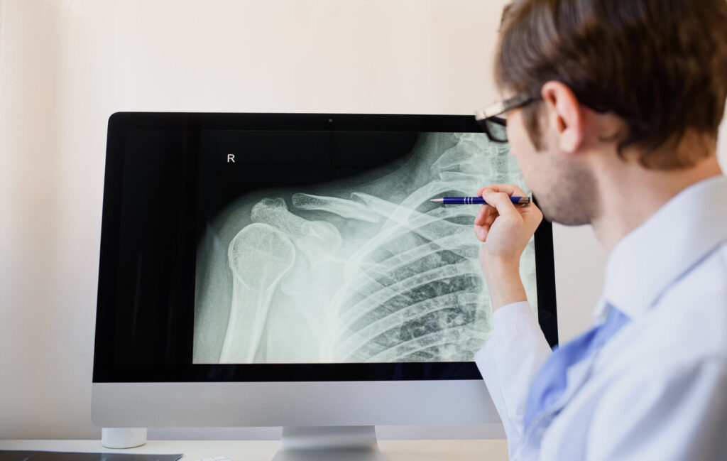 A doctor is analyzing a patient x ray with a clavicle fracture (collarbone fracture).