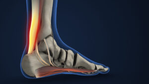 Heel Pain from Achilles Tendon Inflammation