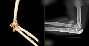 CT scan of elbow joint fracture 3d rendering.