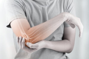 Image of an broken elbow fracture injury.